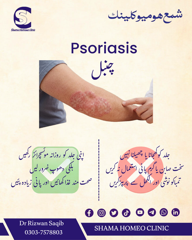 Psoriasis چنبل/ داد/ سورائسز
