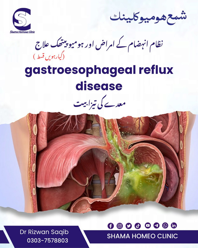  گیسٹرو ایسوفیجل ریفلکس ڈیزیز GERD :