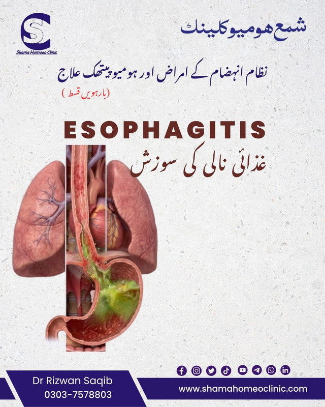  اسوفیگیٹس Esophagitis خوراک کی نالی کی سوزش: 