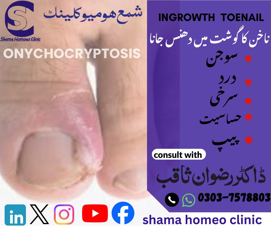 ناخن کا گوشت میں دھنسنا