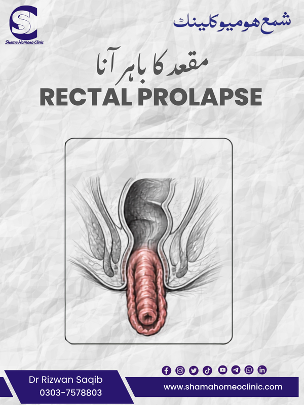 Rectal Prolapse کانچ نکلنا:
