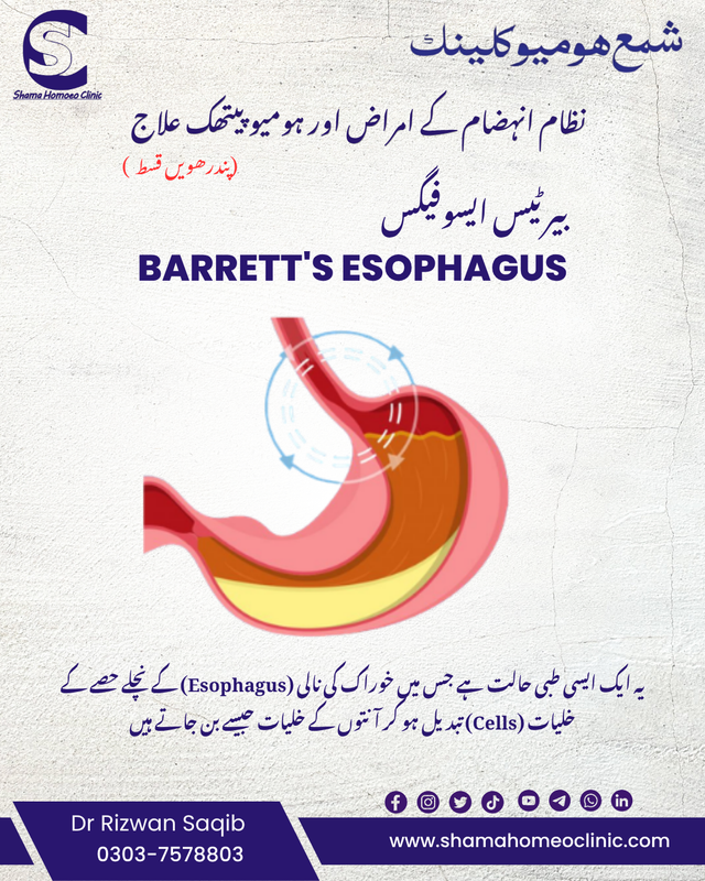 بیرٹیس ایسوفیگس (Barrett's Esophagus) 