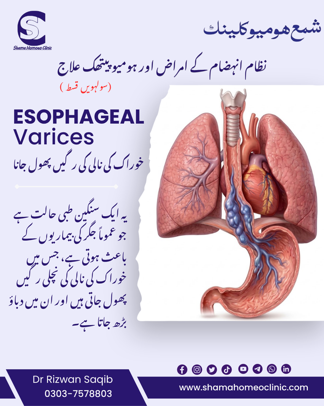Esophageal Varices 